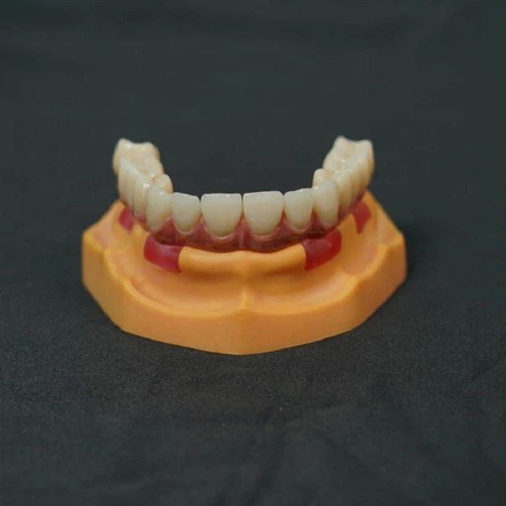 All On Four Implant